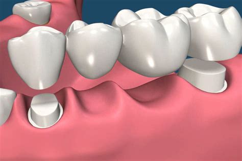 Diferencias Entre Puente Dental E Implantes Dentales Cl Nica Cimpla