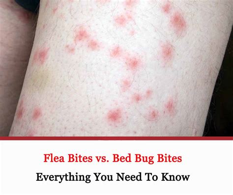 Flea Bites Vs Bed Bug Bites Getridofallthings Com