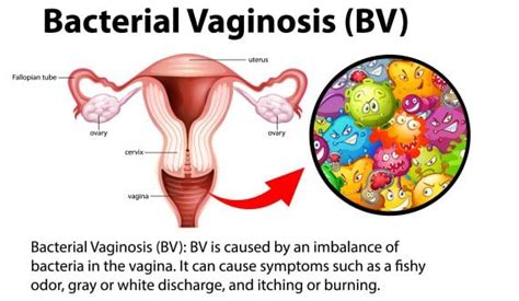 Gardnerella Vaginalis Symptoms Treatment Causes Stdcheck