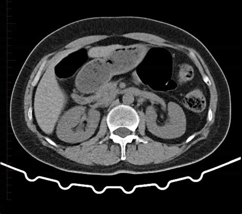 Ct Scan Of The Kidney Diagnostic Imaging Melbourne Radiology