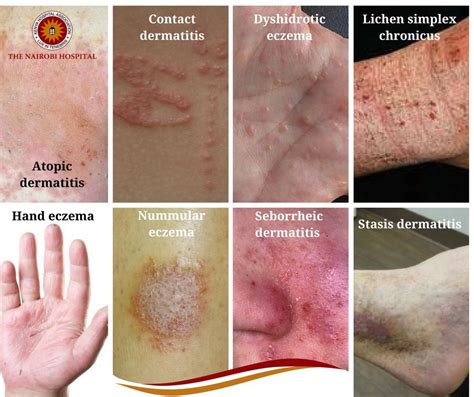 There Are Eight Types Of Eczema The Nairobi Hospital
