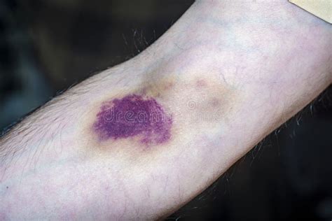 Bruise Marks Stock Photos Free And Royalty Free Stock Photos From