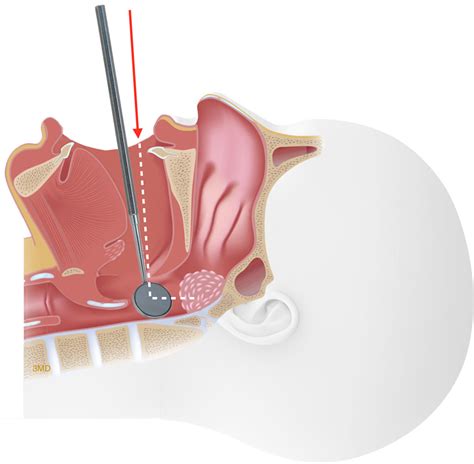 Tonsillectomy And Adenoidectomy T A Fort Worth Ent Sinus