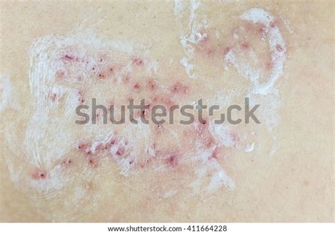 Raised Red Bumps Blisters On Skin Stock Photo 411664228 Shutterstock