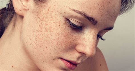 Everything You Need To Know About Freckles Yours Simplified