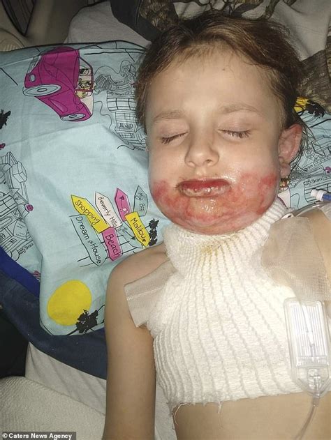 Girl Six Has Been Left With Horrendous Burns On Her Face After Hand