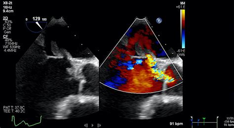 Cureus Triple Valve Endocarditis With Aortic Root Abscess Presenting