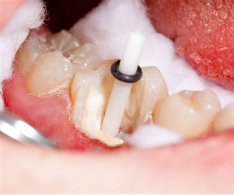 A Pin In A Tooth What Are Pin Teeth How Do They Put With A Denture