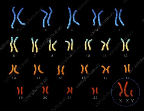 scheme of klinefelter syndrome karyotype of human somatic cell posters sexiz pix
