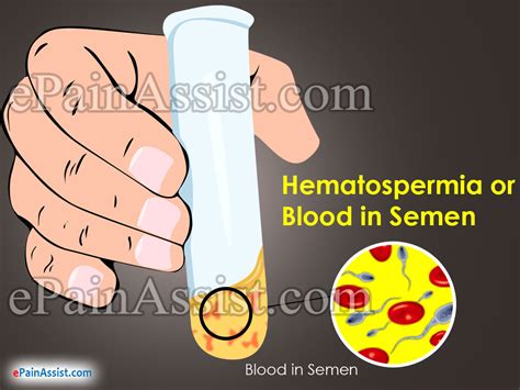 Hematospermia Or Blood In Semen