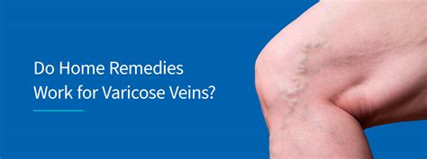 Varicose Vein Home Remedies Natural Vein Treatment
