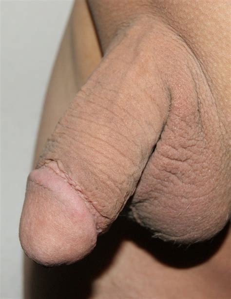 After Circumcision New Pics Xhamster