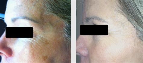 new skinstylus® microneedling before and after photos amae med spa birmingham mi