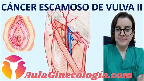 CÁNCER ESCAMOSO DE VULVA II TRATAMIENTO y SEGUIMIENTO Ginecología y