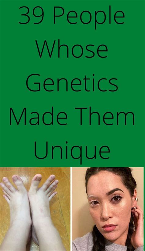 39 People Whose Genetics Made Them Unique Genetics Genetic Mutation