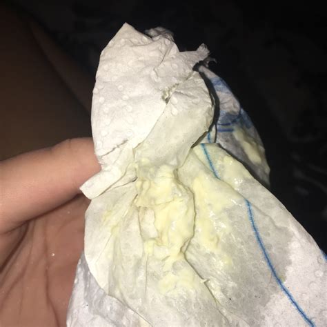 Yellow And Chunky Discharge Is This A Bad Yeast Infection Help