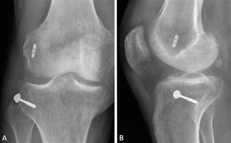 Postoperative Radiographs Of The Right Knee At 1 Year Follow Up