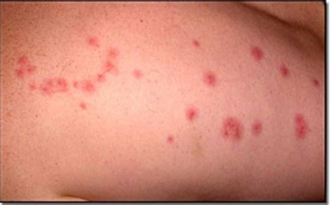 Understanding Chigger Bites Symptoms And Treatment