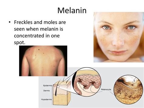 Understanding Freckles Causes Treatments And Prevention Justinboey