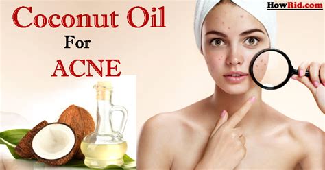Coconut Oil For Acne Use Coconut Oil For Acne