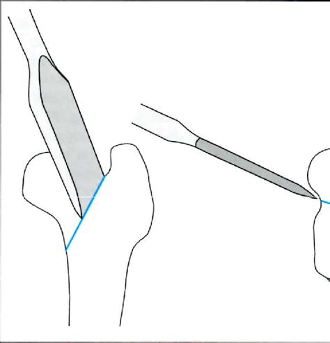 Direction Of The Osteotome During Osteotomy Of The Femoral Neck
