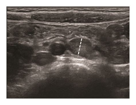 Abdominal Ultrasound Showing Large Hypoechoic Mesenteric Lymph Nodes In