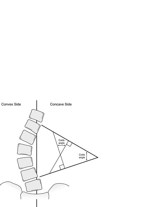Escoliosis idiopática - Pediatría - Manual MSD versión para profesionales