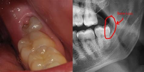 What Is An Impacted Wisdom Tooth Okanagan Dentistry