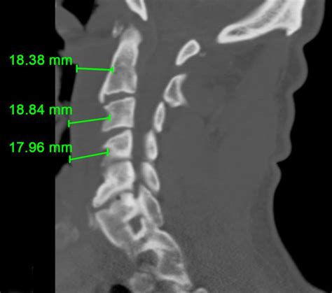 Ct Scan Of Cervical Spine Patient 4 Showing An Increase In The