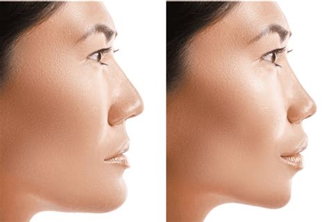 Maybe you would like to learn more about one of these? How Long Does It Take To Recover From a Nose Surgery ...