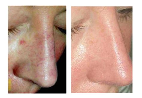Before And After Photos Newsurg Next Generation Lasers