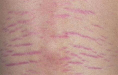 The Difference Between Red And White Stretch Mark Sculptdtlacom