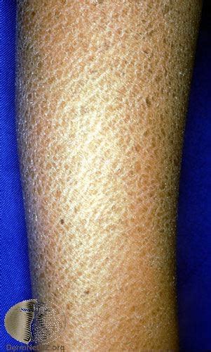 Xerosis And Dry Skin Treatment Colorado Springs Xerosis Of Skin