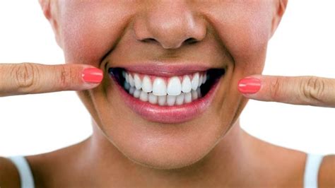 Sonrisas Perfectas El Nuevo Universo De Las Carillas Dentales MDZ Online