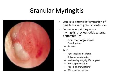 Granular Myringitis