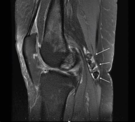 Knee Magnetic Resonance Imaging With Sagittal T2 Sequences Demonstrate