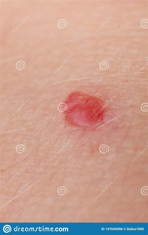 Cherry Angiomas On Male Skin Super Macro Close Up Stock Photo Image