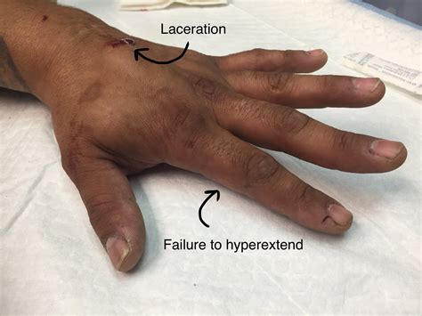 Extensor Tendon Injuries Of The Hand