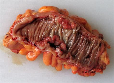 Has the cancer spread to other parts of the body? Medicina Inteligente: Cáncer de colon se podría curar en ...