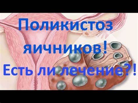 Поликистоз яичников диета для похудения
