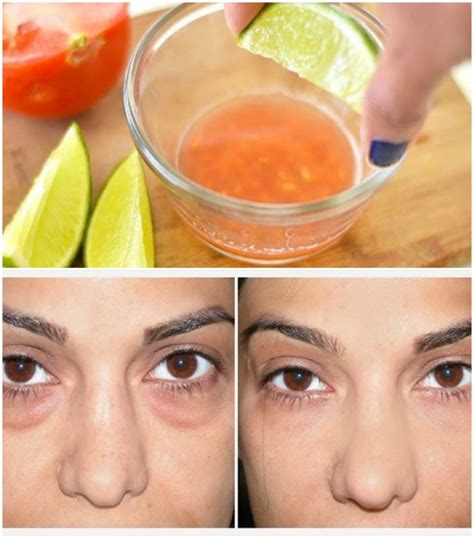 Effective Homemade Remedies For Dark Circles Under Your Eyes All For