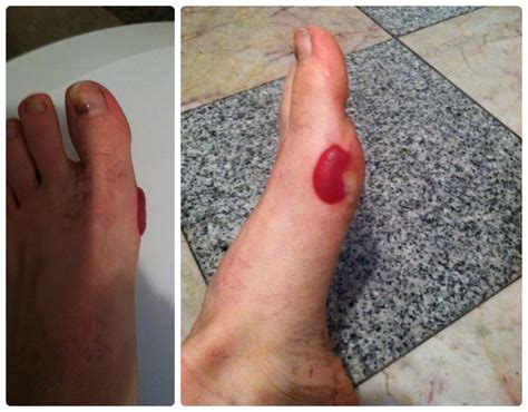 Runners Feet 101 Prevention And Care Of Black Toenails Blisters
