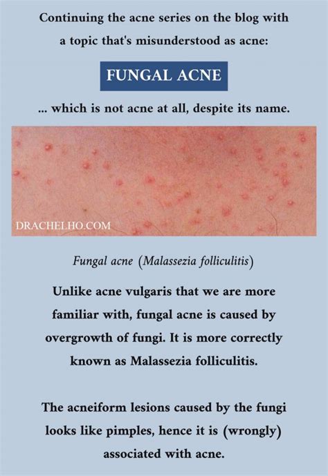 Dr Rachel Ho Fungal Acne Is Not Acne At All Malassezia Folliculitis