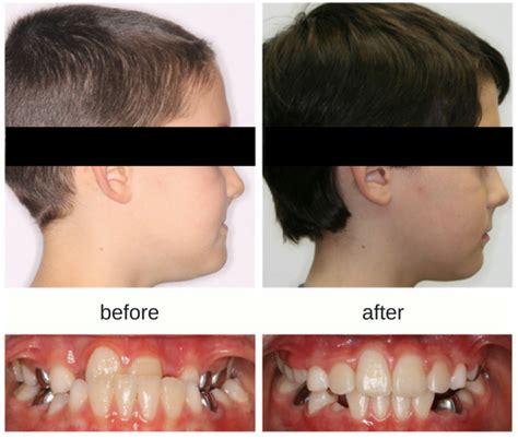 How To Correct An Underbite Methodchief7