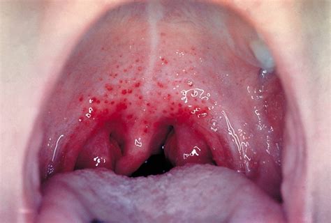Strep Throat Symptoms Causes Mayo Clinic