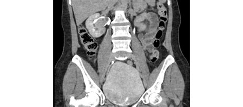 Figure 2 Computed Tomography Ct Urography Excretory Phase Coronal