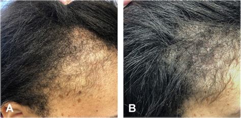 Minoxidil Before And After Photos And Results Wimpole Clinic
