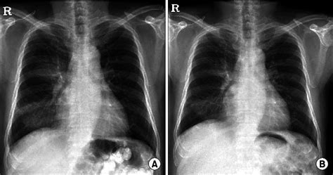 A Initial Chest X Ray Shows A Consolidation Of The Right Lower Lung