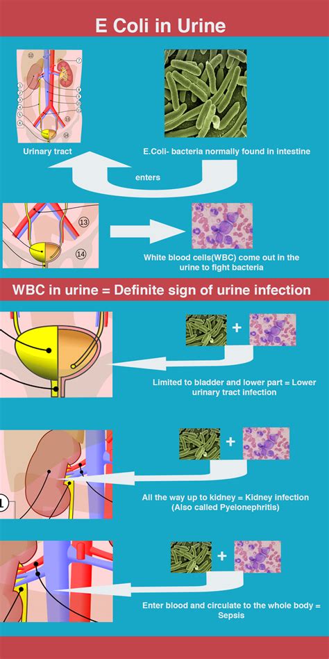 Have E Coli In Urine Here Is What It Means
