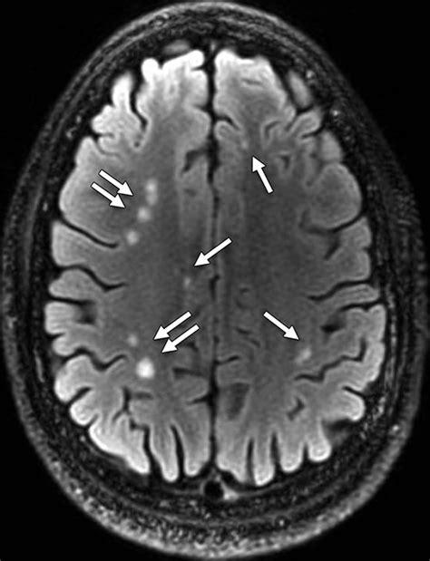 Mri Shows ‘brain Scars In Military Personnel With Blast Related Concussion